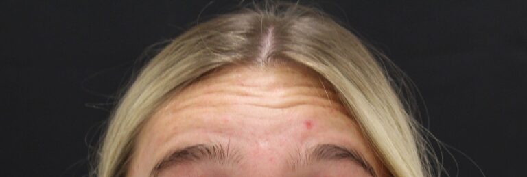 Before Image: Neurotoxin - front