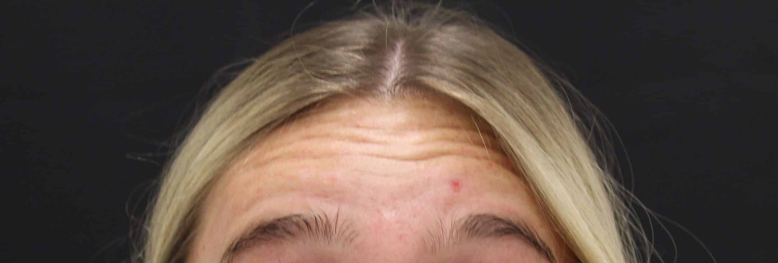 Before Image: Neurotoxin - front