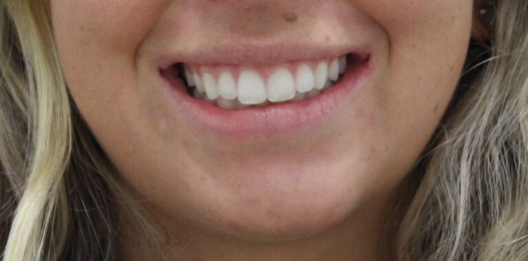 Before Image: Neurotoxin Lip Flip - front