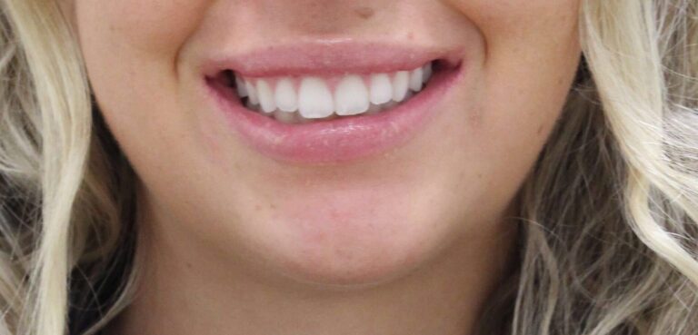 After Image: Neurotoxin Lip Flip - front