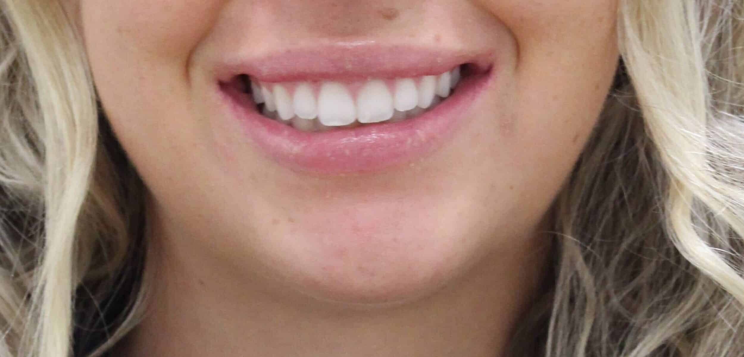 After Image: Neurotoxin Lip Flip - front