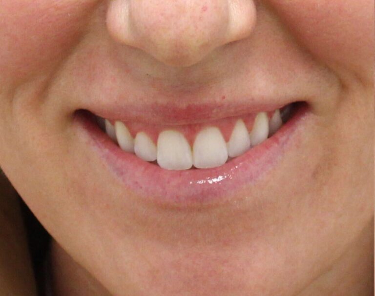 Before Image: Neurotoxin Lip Flip - front