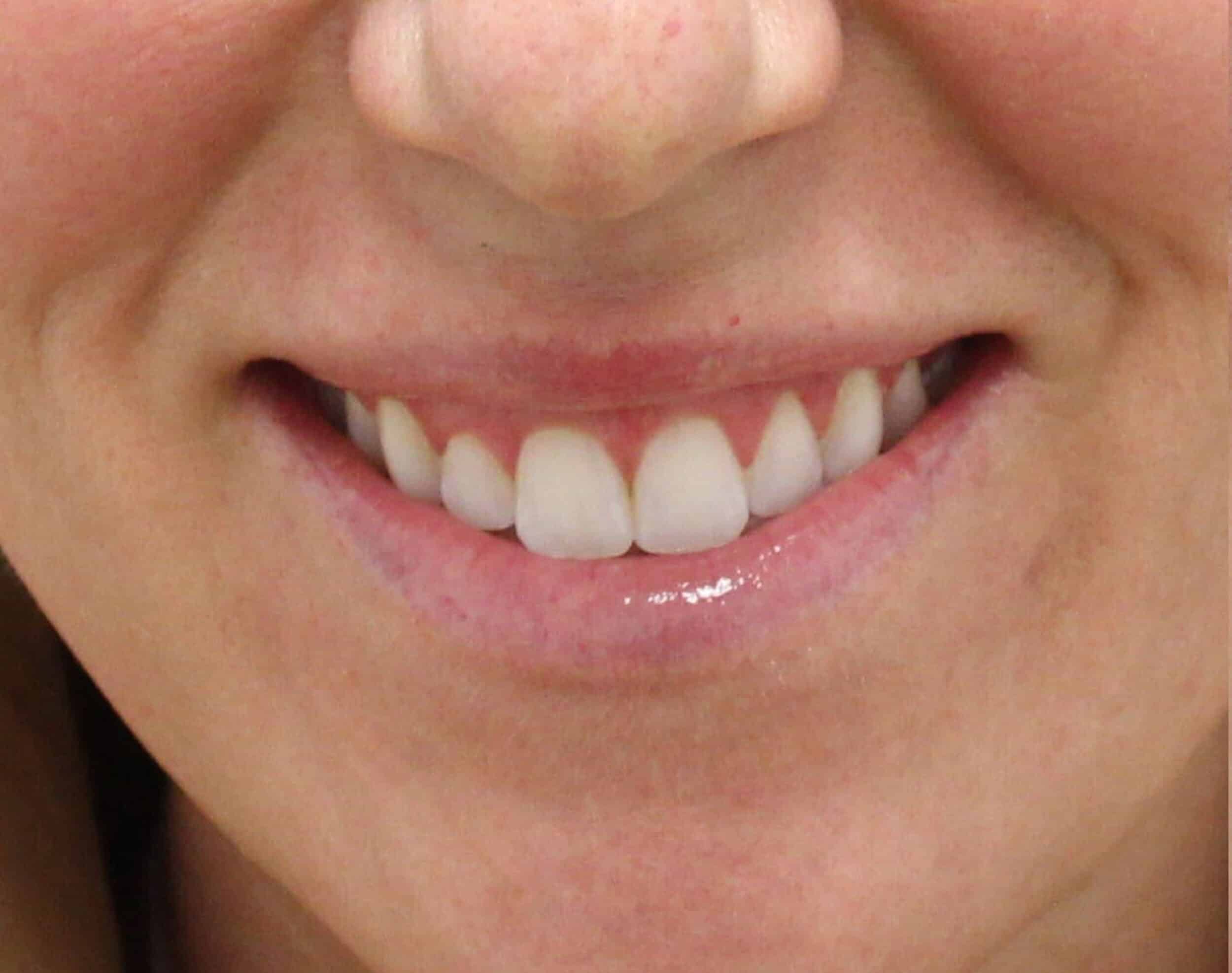 Before Image: Neurotoxin Lip Flip - front