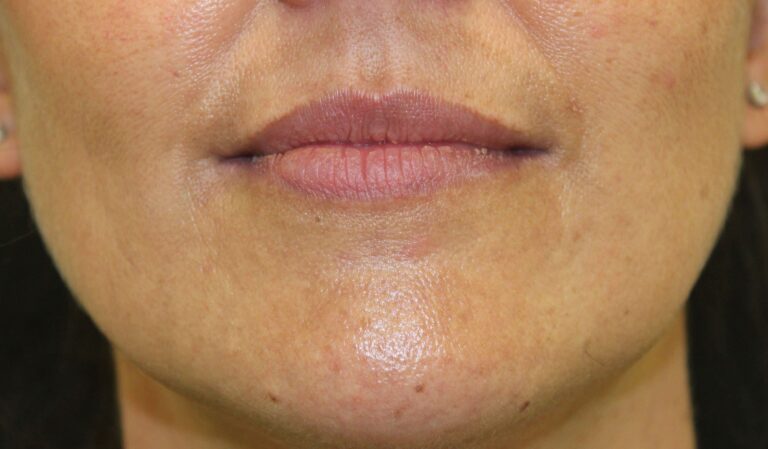 Before Image: Lip Filler - front