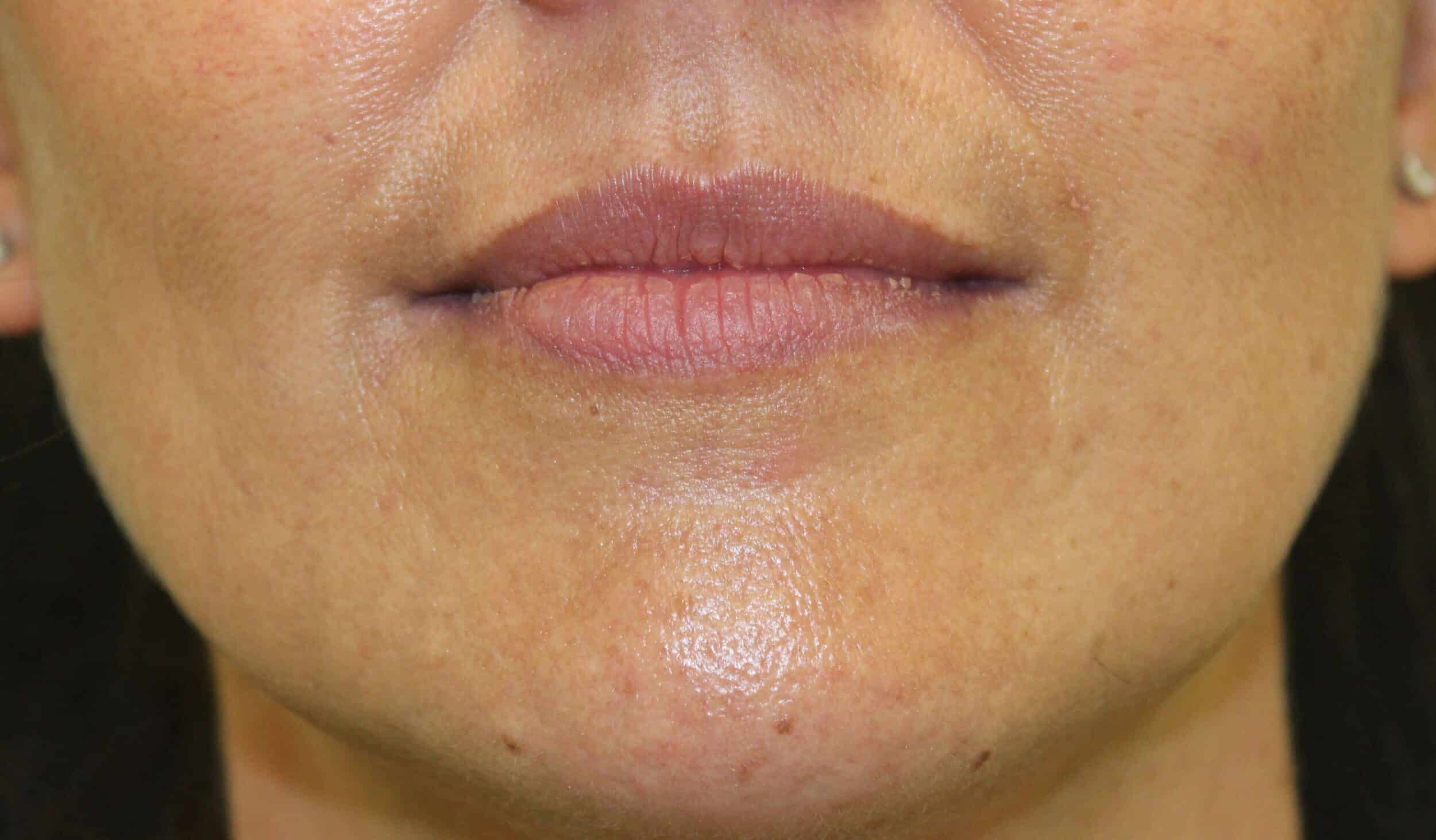 Before Image: Lip Filler - front