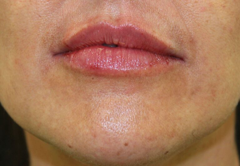 After Image: Lip Filler - front