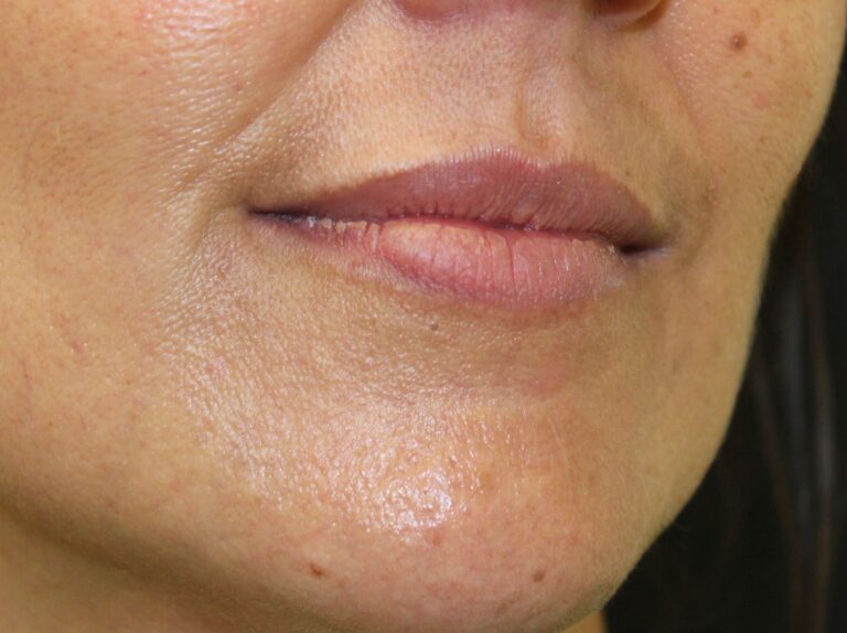 Before Image: Lip Filler -