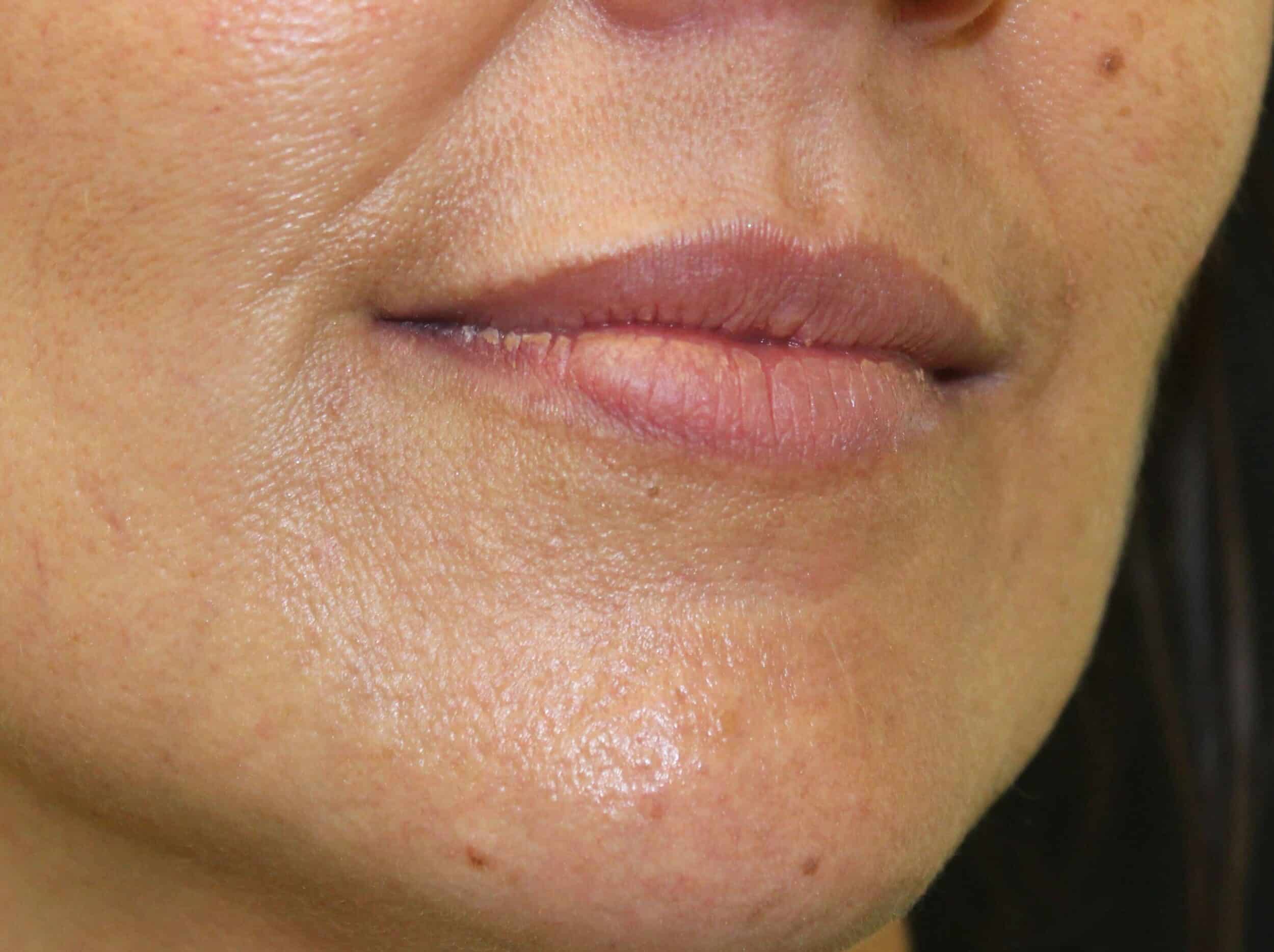 Before Image: Lip Filler - front