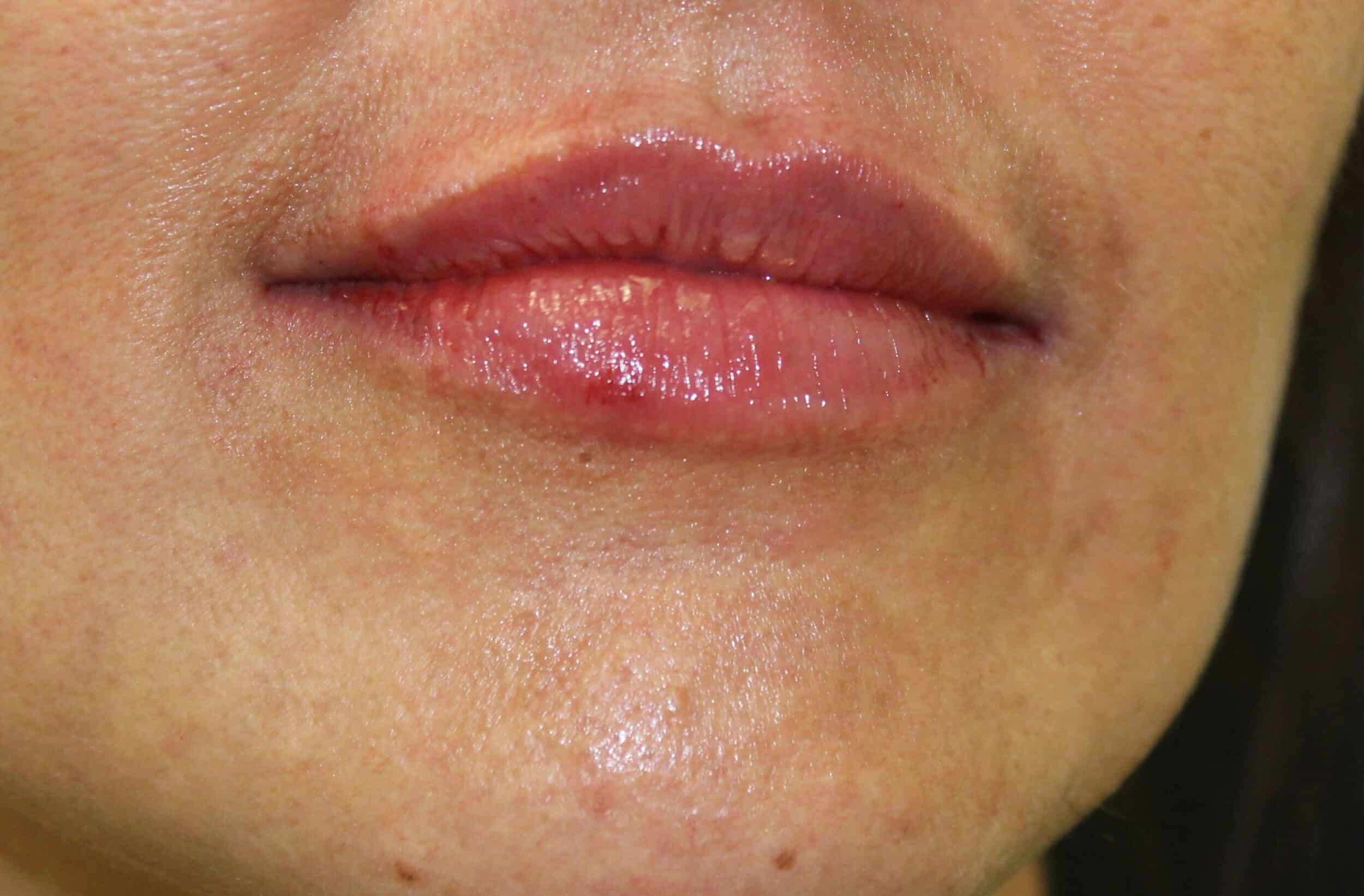 After Image: Lip Filler - front