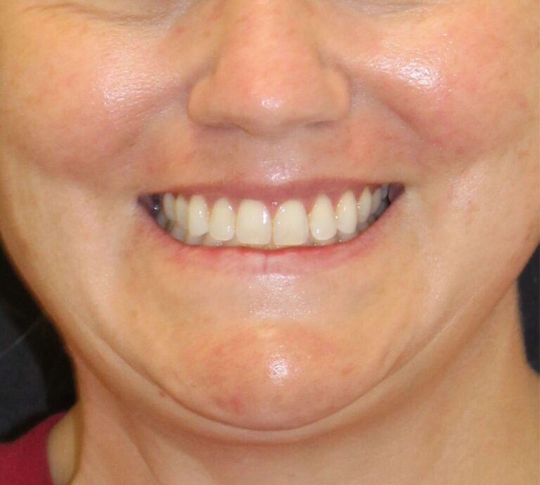 Before Image: Neurotoxin Lip Flip - front