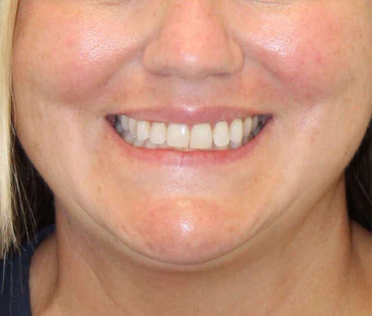 After Image: Neurotoxin Lip Flip - front