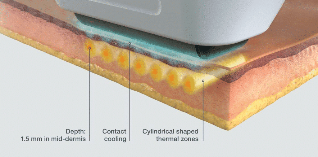Sofwave Treatment Tuscaloosa AL Sofwave Treatment Tuscaloosa AL