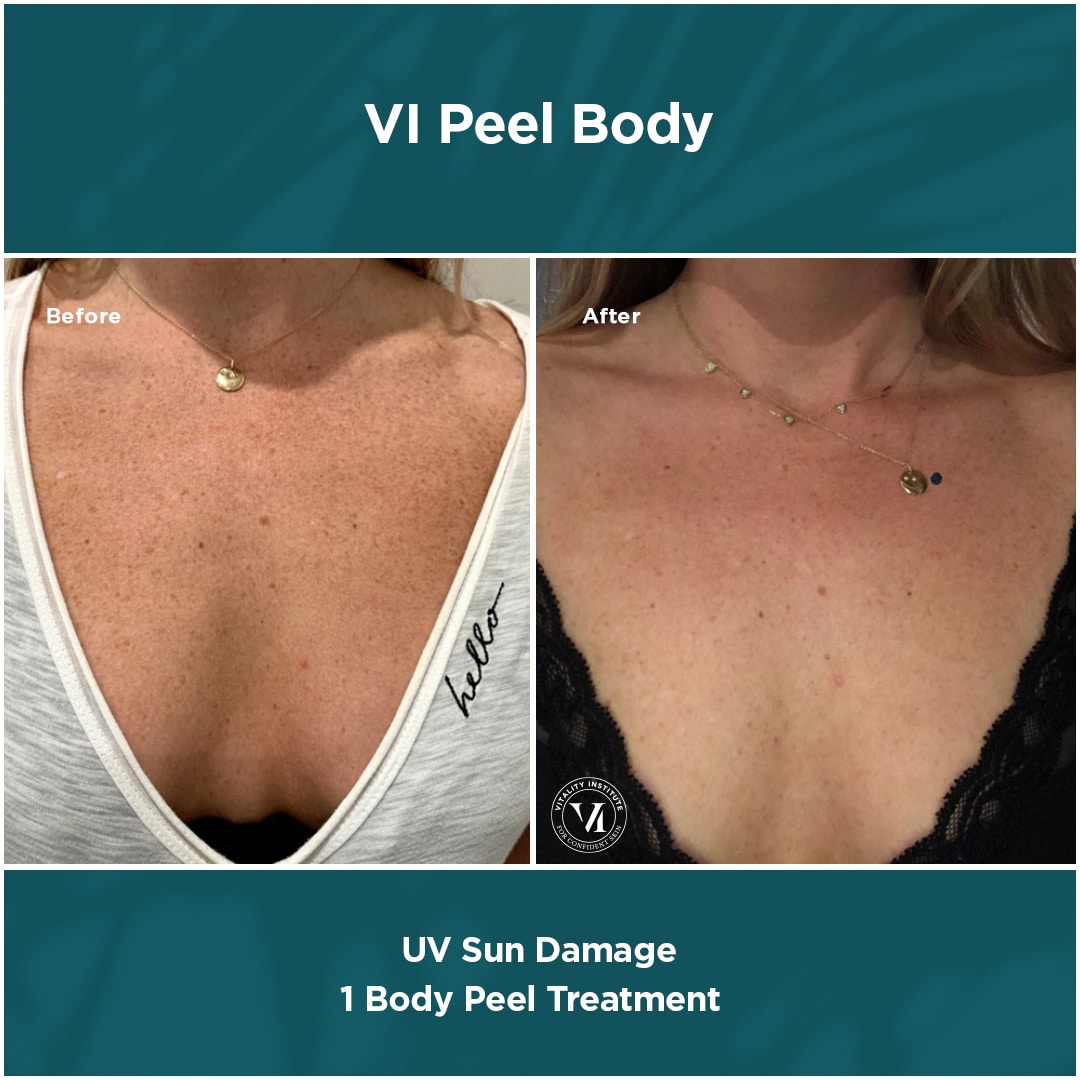 UV-Sun-Damage UV-Sun-Damage