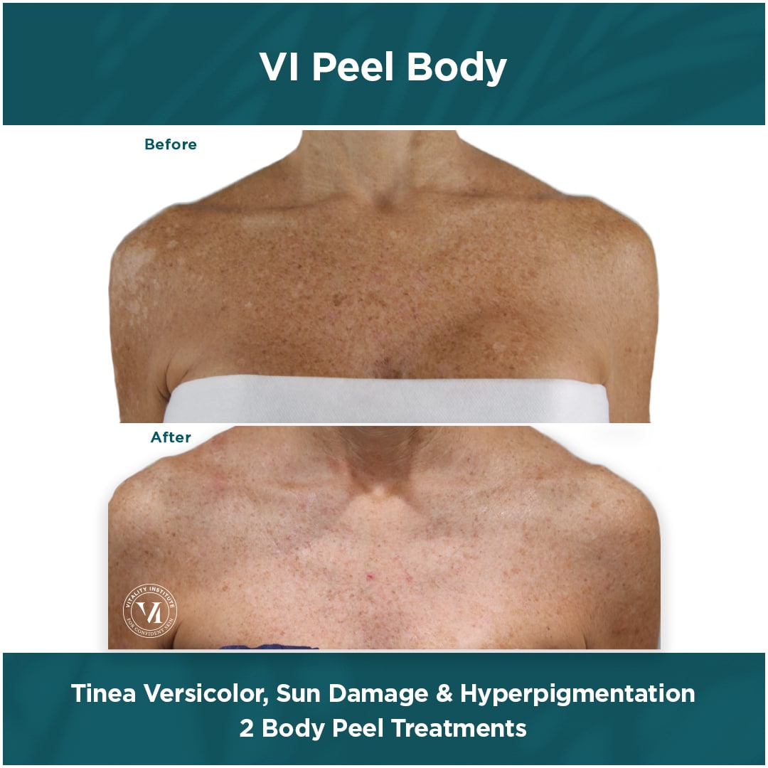 BodyPeel_TineaVersicolor BodyPeel_TineaVersicolor