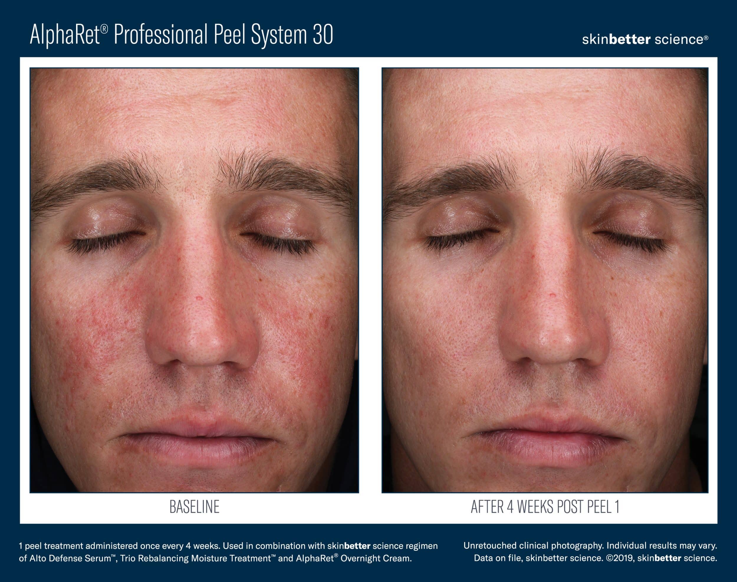 AlphaRet Professional Peel System Before_After JPEG Template(HQP)2 AlphaRet Professional Peel System Before_After JPEG Template(HQP)2