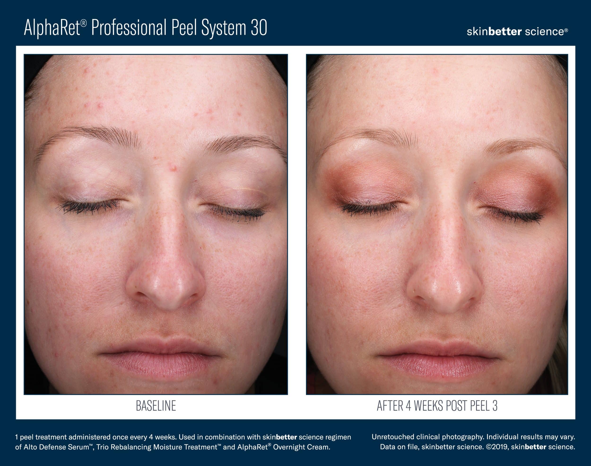 AlphaRet Professional Peel System Before_After JPEG Template(HQP)3 AlphaRet Professional Peel System Before_After JPEG Template(HQP)3