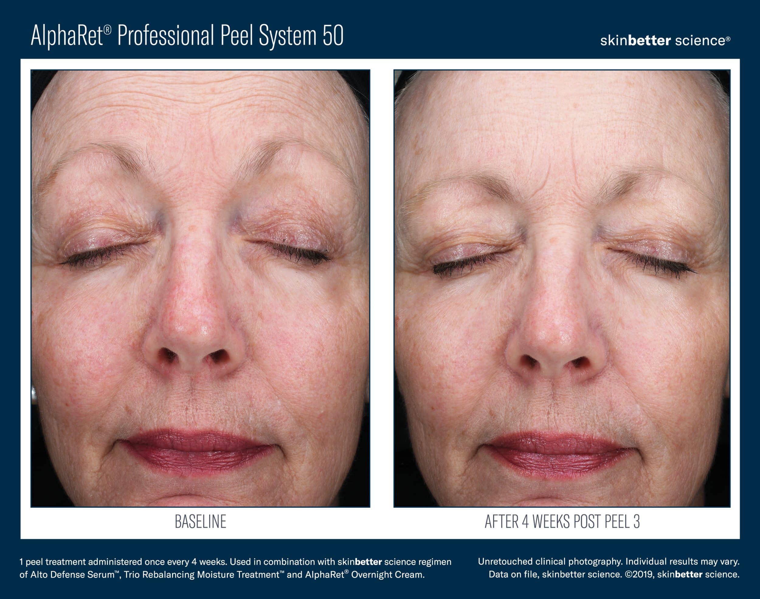 AlphaRet Professional Peel System Before_After JPEG Template(HQP)5 AlphaRet Professional Peel System Before_After JPEG Template(HQP)5