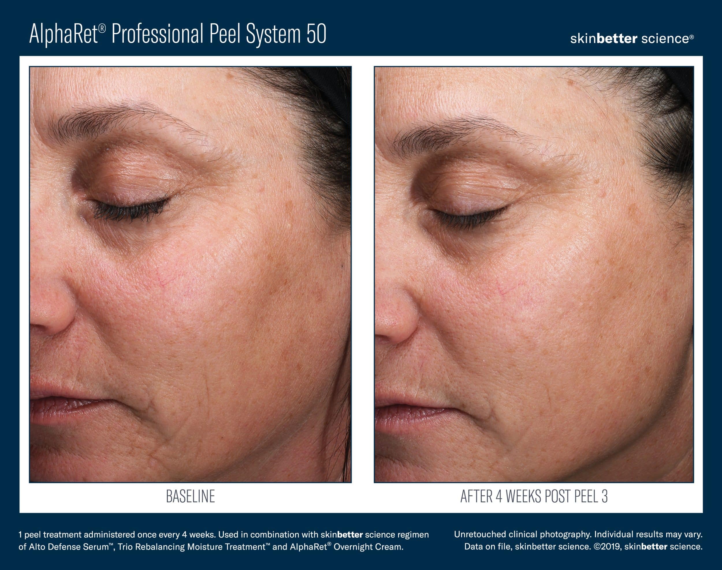 AlphaRet Professional Peel System Before_After JPEG Template(HQP)6 AlphaRet Professional Peel System Before_After JPEG Template(HQP)6