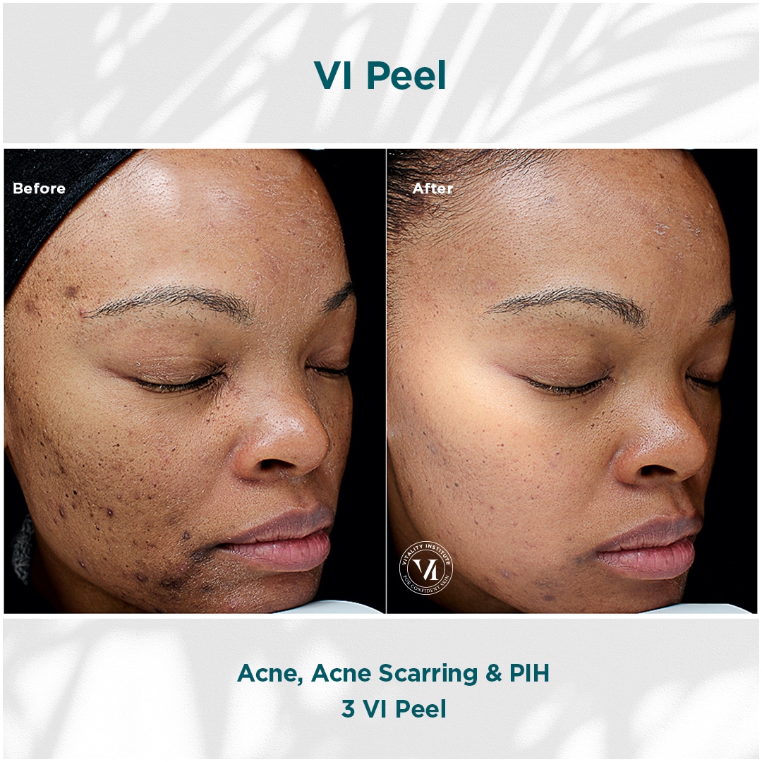 Acne, Scarring _ PIH_02 Acne, Scarring _ PIH_02