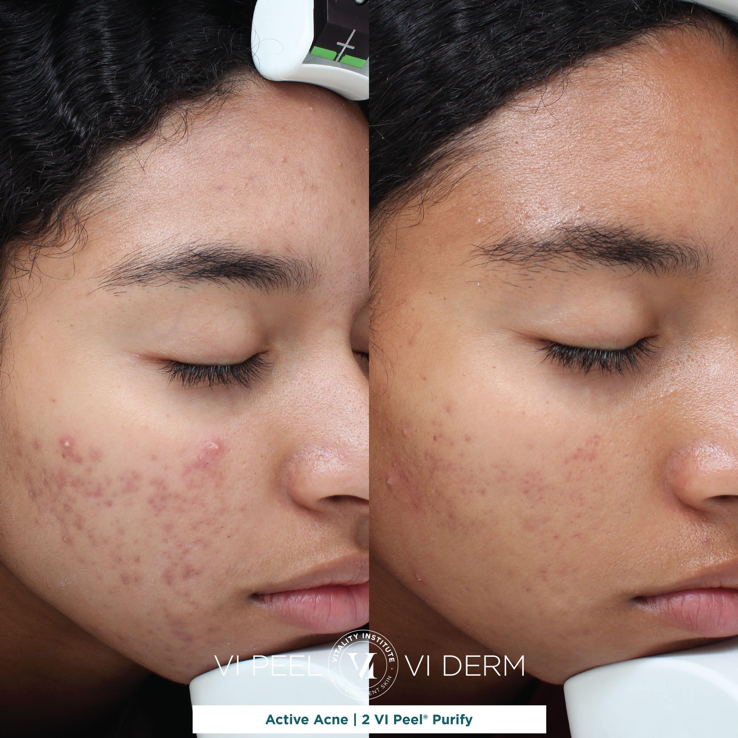 Active Acne_2 VI Peel Purify_Graphic Active Acne_2 VI Peel Purify_Graphic