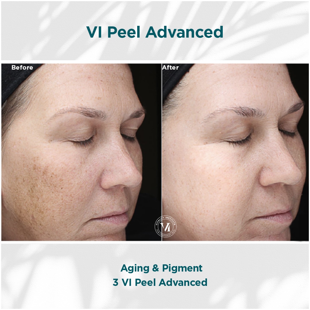Aging _ Pigment Aging _ Pigment