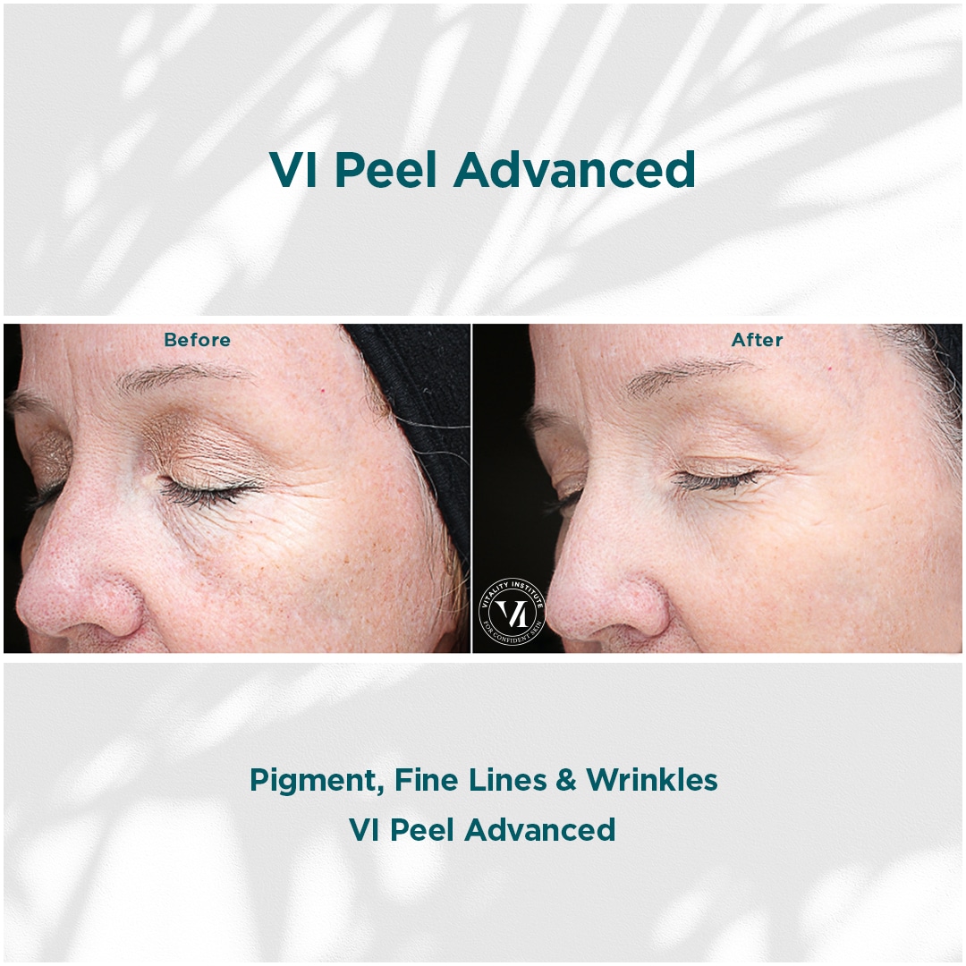 Pigment, Fine Lines _ Wrinkles Pigment, Fine Lines _ Wrinkles