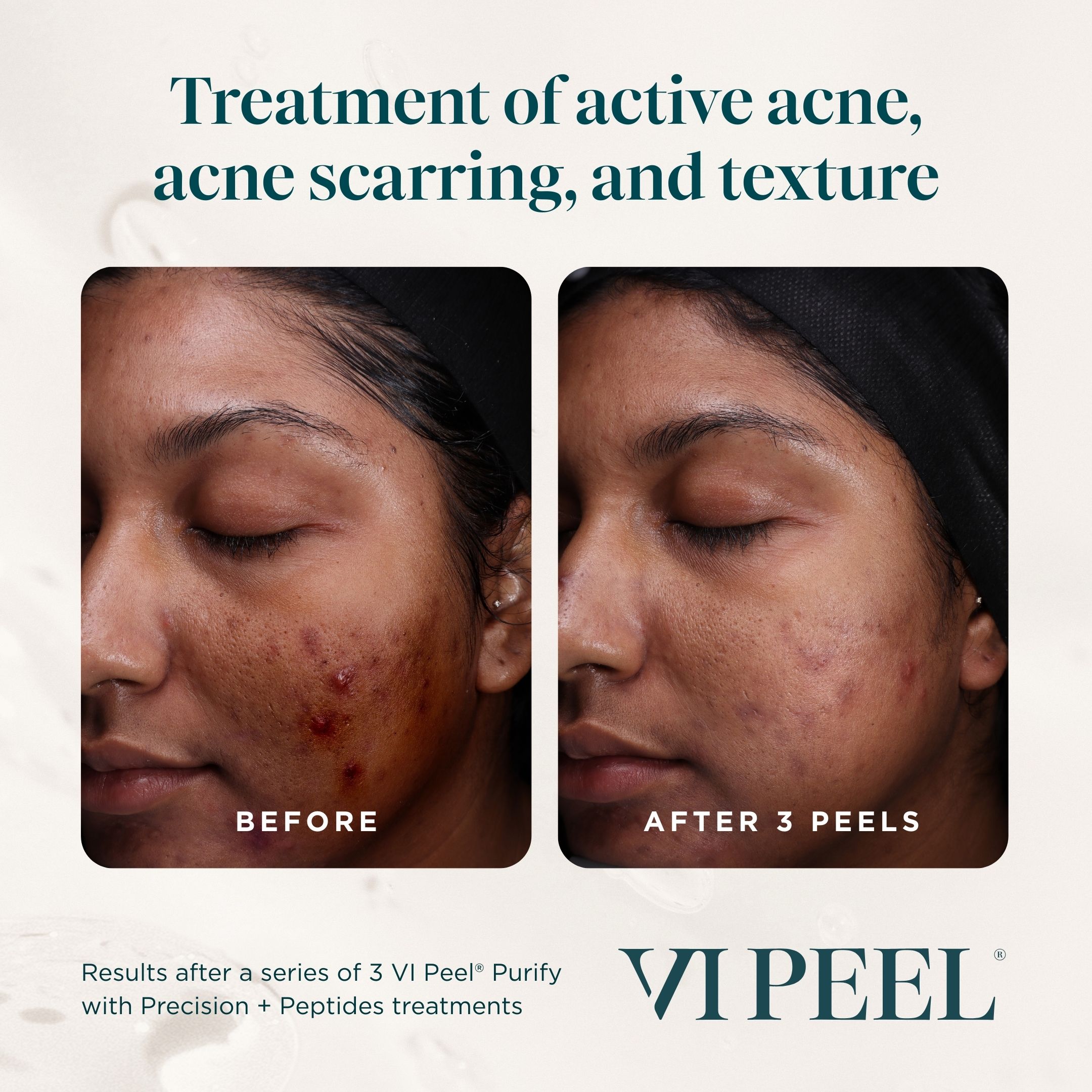 Purify w Precision Peptides BA Purify w Precision Peptides BA