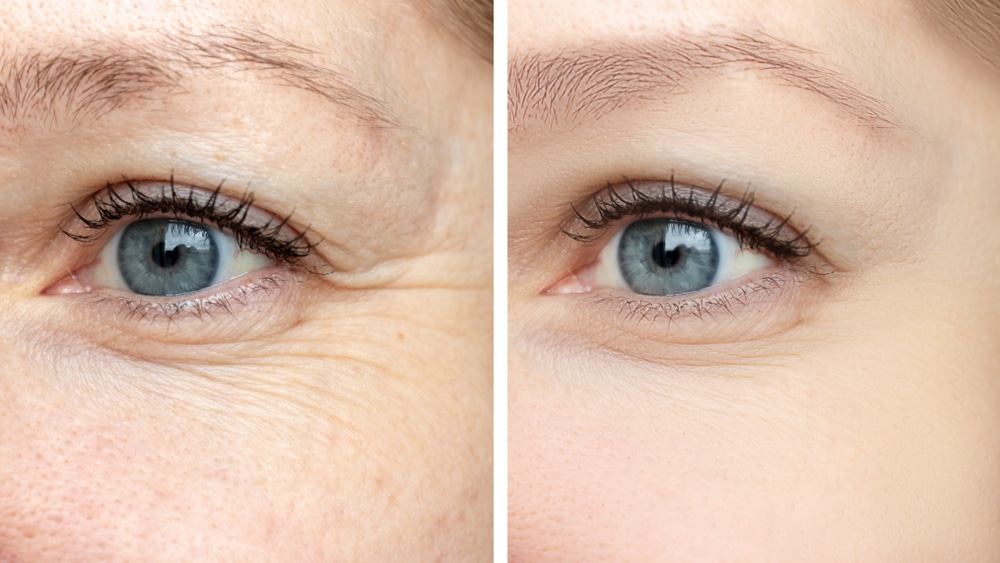 Dysport treatment results showing reduced eye wrinkles before and after cosmetic injections.